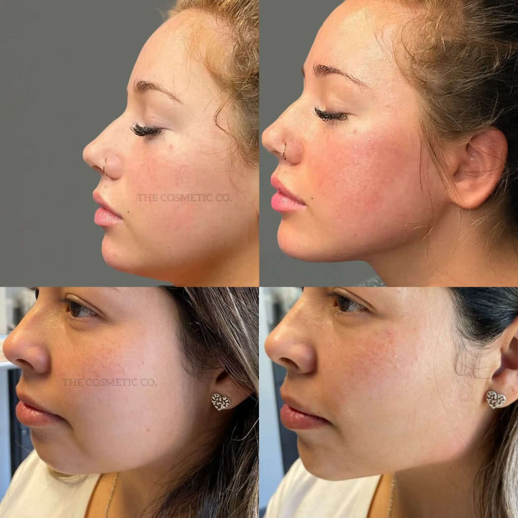 Face Slimming Bandage & V-Line Chin Lift Belt – Reusable Facial Strap for Skin Care & Firming