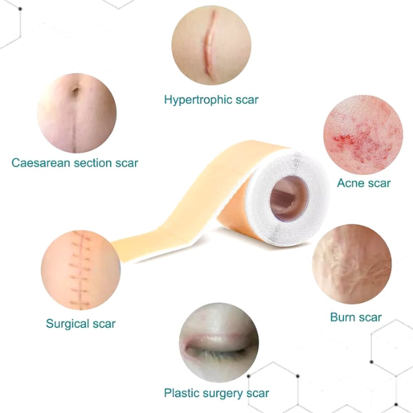 Silicone Scar Sheets – Best Rated Solution for Before & After Care