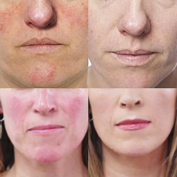 Rosacea Treatment Cream | All-Natural, Fast-Absorbing Formula for Redness & Acne Relief on Sensitive Skin