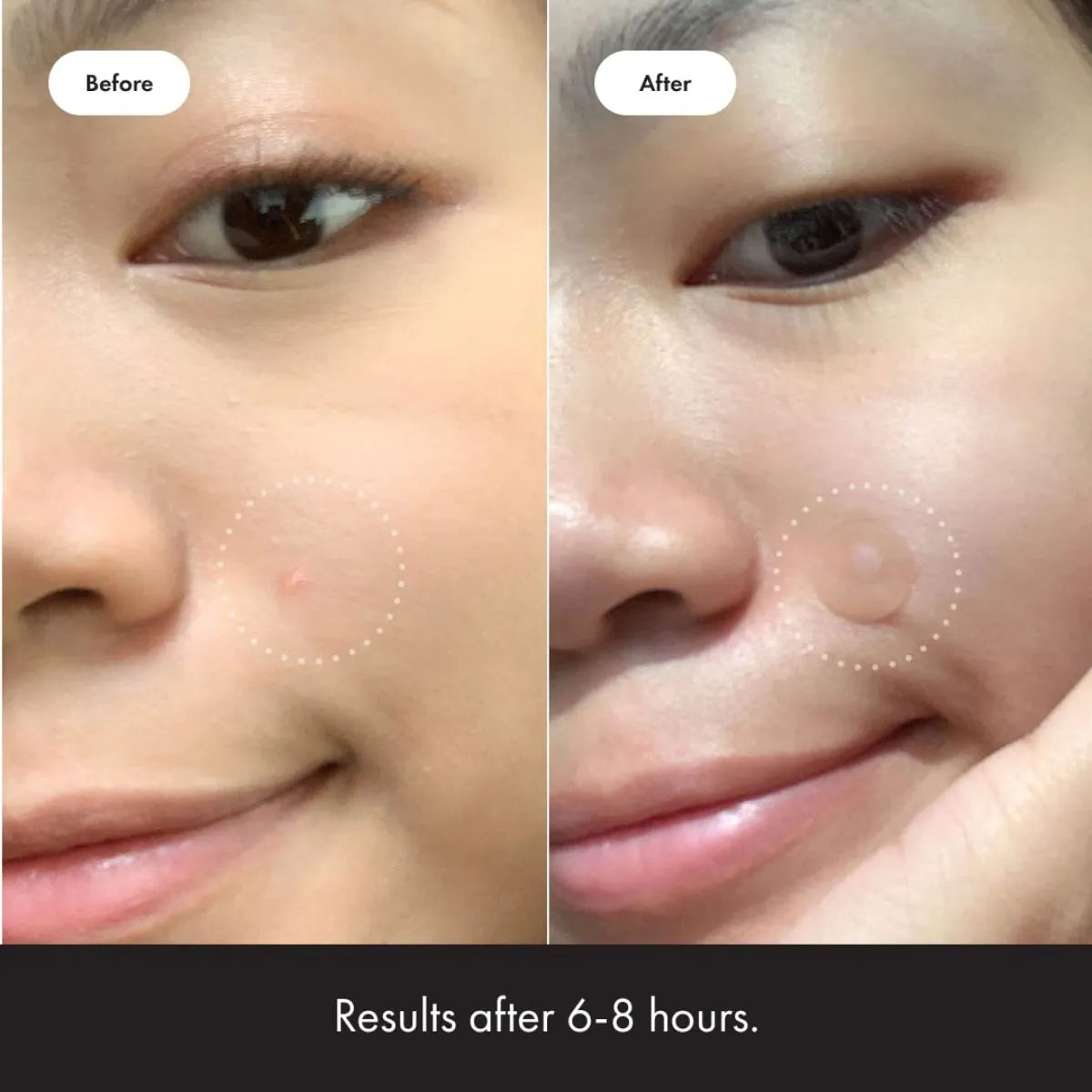 Anti-Pimple Hydrocolloid Patches | Non-Drying, Hypoallergenic & Discreet for All Skin Types
