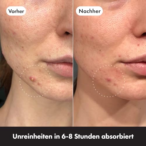 Anti-Pimple Hydrocolloid Patches | Non-Drying, Hypoallergenic & Discreet for All Skin Types