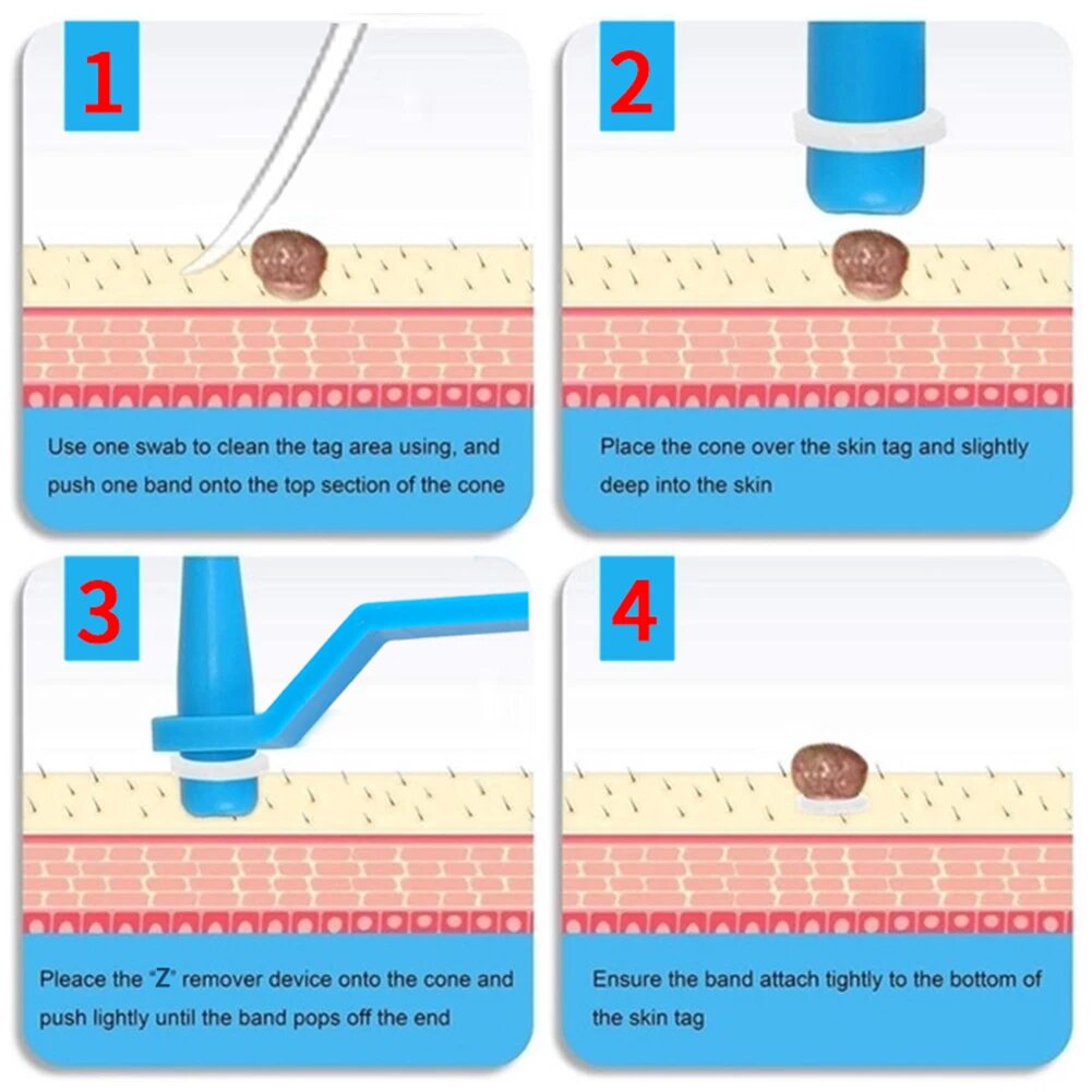 Skin Tag Removal Kit | 2-in-1 Silicone Band Ligation System for Safe and Gentle Home Use