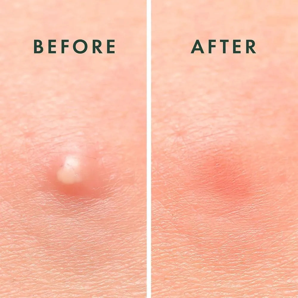 Anti-Pimple Hydrocolloid Patches | Non-Drying, Hypoallergenic & Discreet for All Skin Types
