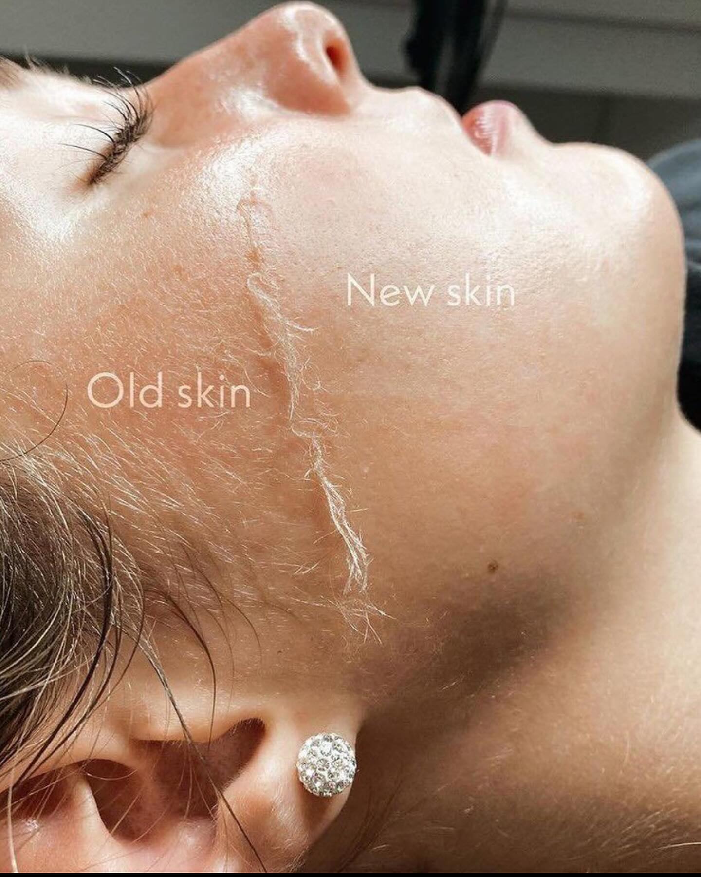 Sonic Dermaplaning Device | Microfine Edges for Smooth Skin & Enhanced Skincare Absorption