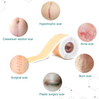 Silicone Scar Sheets – Best Rated Solution for Before & After Care
