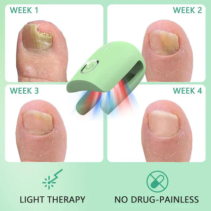 Fungal Nail Treatment Device – Fast & Effective Onychomycosis Solution