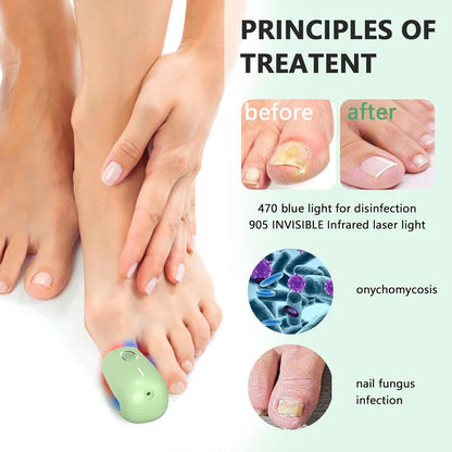 Fungal Nail Treatment Device – Fast & Effective Onychomycosis Solution