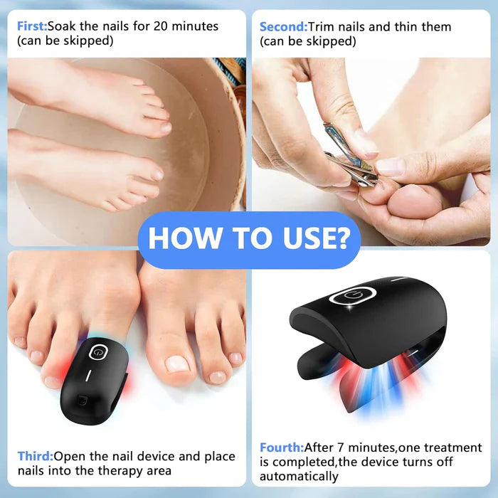 Fungal Nail Treatment Device – Fast & Effective Onychomycosis Solution