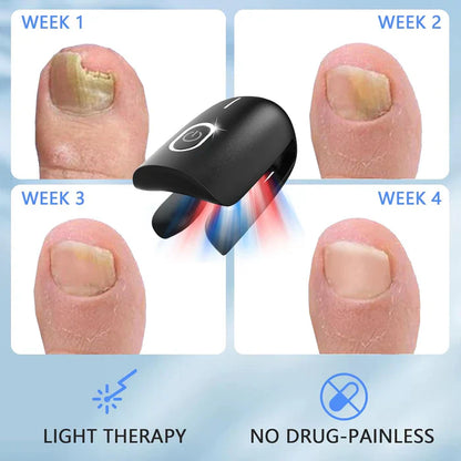 Fungal Nail Treatment Device – Fast & Effective Onychomycosis Solution