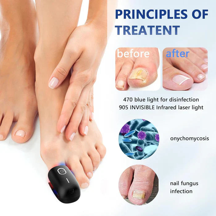 Fungal Nail Treatment Device – Fast & Effective Onychomycosis Solution