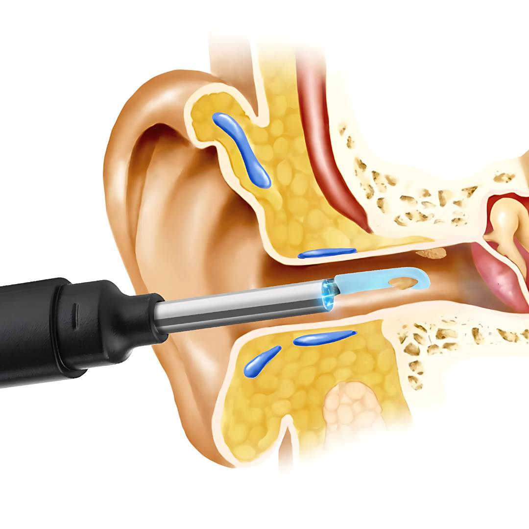 Earwax Removal Tool with LED Camera | Safe, Soft Tips for Gentle Ear Cleaning and Monitoring Ear Health