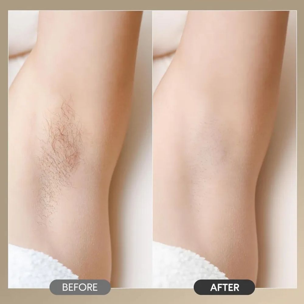 IPL Laser Hair Remover | Permanent Hair Removal, Skin-Friendly & Ideal for Legs, Arms, Face, and Intimate Areas