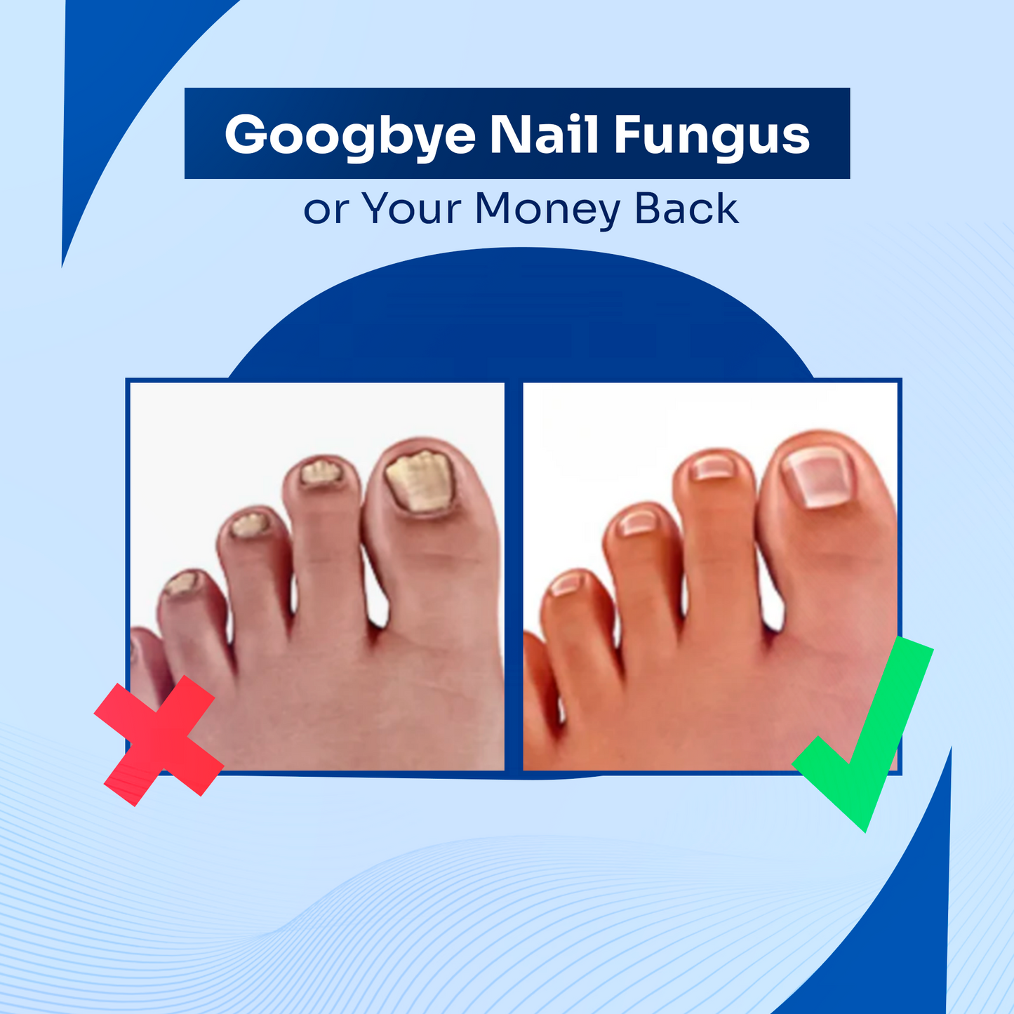 Nail Fungus Laser Treatment Device | Laser Therapy for Nail Fungus Removal