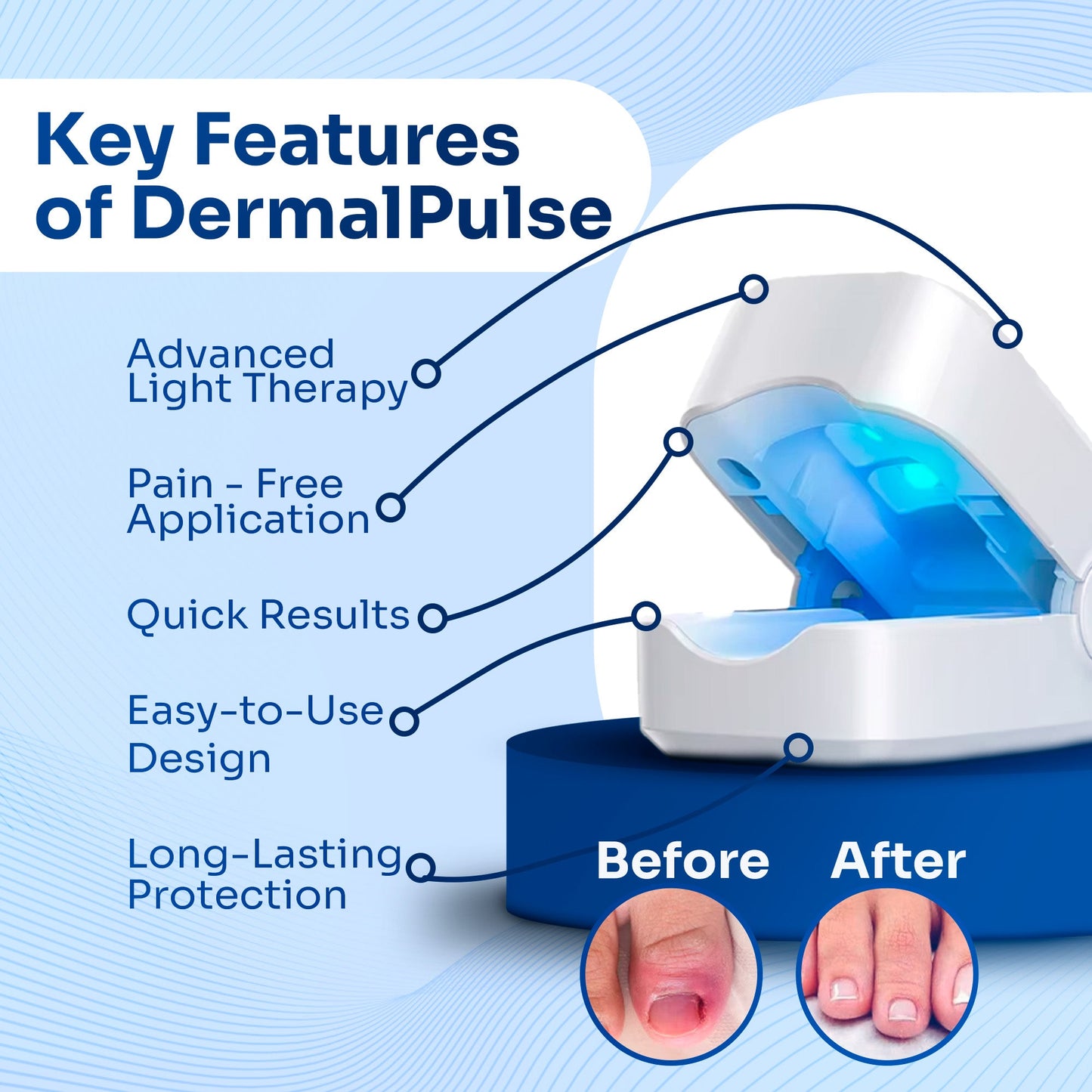 Nail Fungus Laser Treatment Device | Laser Therapy for Nail Fungus Removal