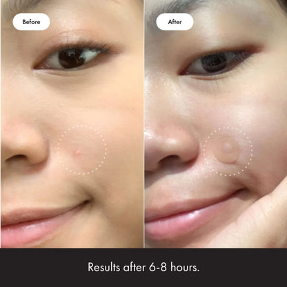 Anti-Pimple Hydrocolloid Patches | Non-Drying, Hypoallergenic & Discreet for All Skin Types