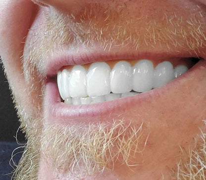 Pop-On Veneers for Instant Smile Makeover | Custom Fit Dental Aesthetic Solution for Teeth Whitening & Gap Coverage