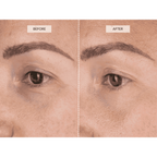 LED Eye Perfector – Advanced Under Eye Bags & Dark Circles Reduce Treatment