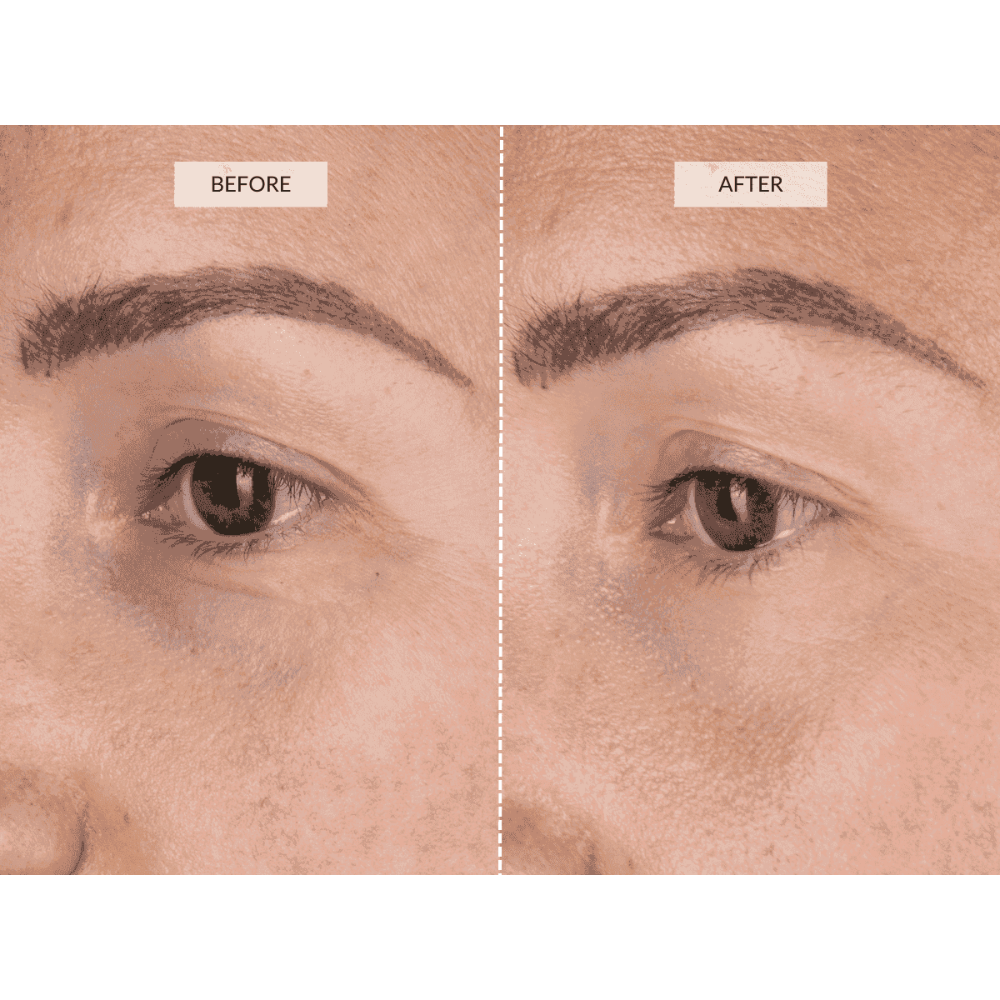 LED Eye Perfector – Advanced Under Eye Bags & Dark Circles Reduce Treatment