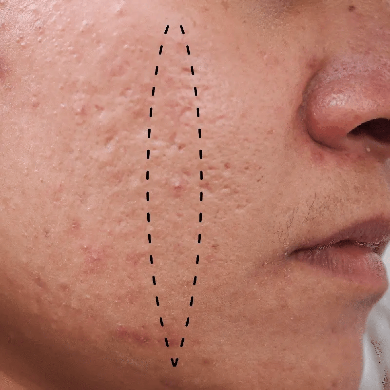 Whitening Freckle Cream for Dark Spot Removal and Skin Brightening - Effective Treatment for Hyperpigmentation and Uneven Skin Tone