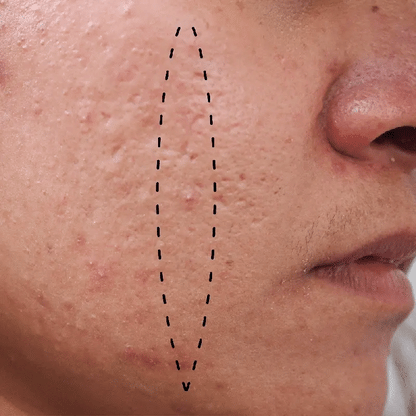 Whitening Freckle Cream for Dark Spot Removal and Skin Brightening - Effective Treatment for Hyperpigmentation and Uneven Skin Tone
