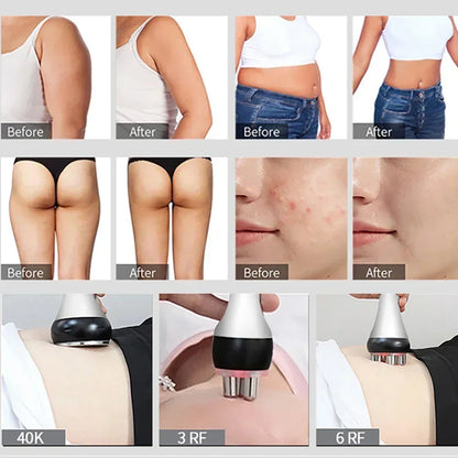 Ultrasonic Cavitation Machine 40K with RF for Facial Lifting, Body Slimming & Weight Loss Treatments