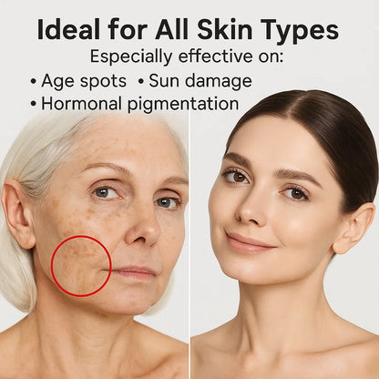 Whitening Freckle Cream for Dark Spot Removal and Skin Brightening - Effective Treatment for Hyperpigmentation and Uneven Skin Tone