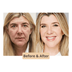 The Instant Neck and face Lift l No Pain Neck Lift Stretch Bands