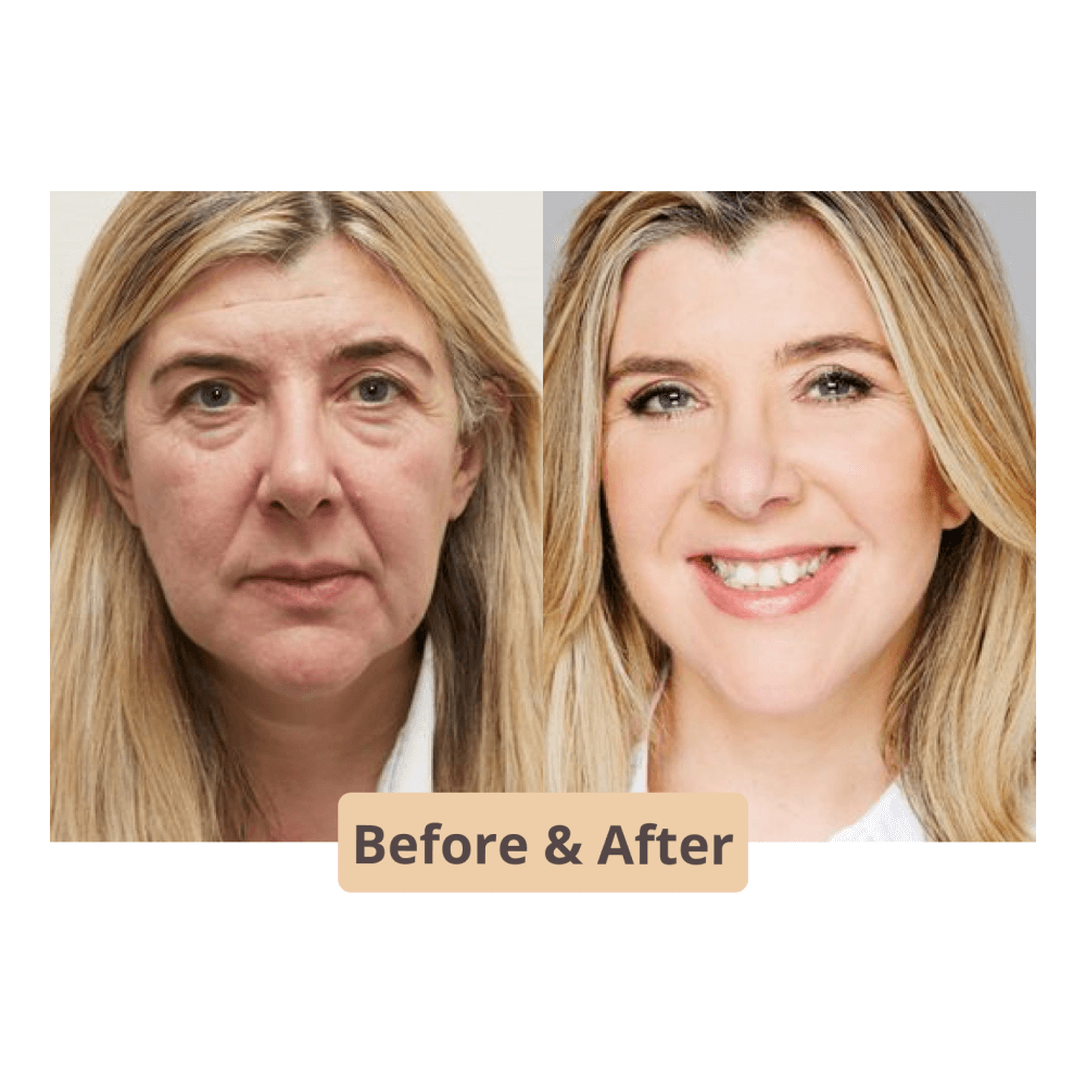 The Instant Neck and face Lift l No Pain Neck Lift Stretch Bands