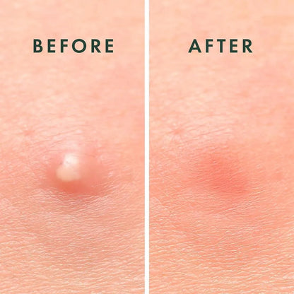 Anti-Pimple Hydrocolloid Patches | Non-Drying, Hypoallergenic & Discreet for All Skin Types