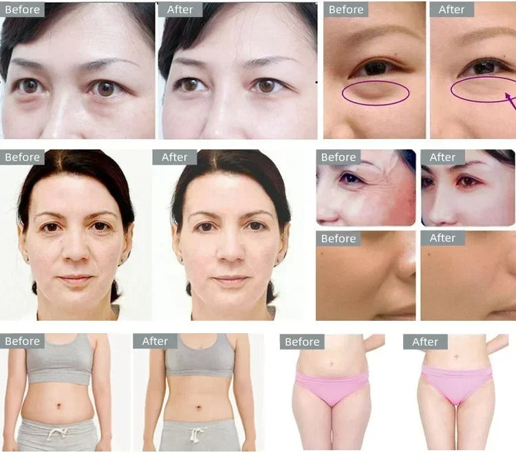 Ultrasonic RF Therapy for Face and Body - 3-in-1 Body 40KHZ Contouring Machine for Slimming and Sculpting